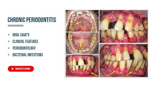 Chronic periodontitis Etiology Clinical features periodontal health [upl. by Okajima]