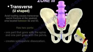 Sacral Fractures  Review  Everything You Need To Know  Dr Nabil Ebraheim [upl. by Ansaev]