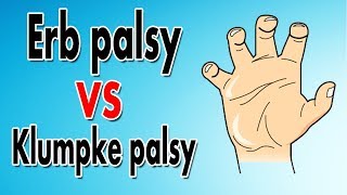 Erbs Palsy vs Klumpkes Palsy [upl. by Tarr403]