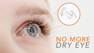 Say Goodbye to Dry Eyes with Punctal Plugs [upl. by Langbehn]