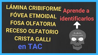 💀LÁMINA CRIBOSA DEL ETMOIDES TAC y otras estructuras de la base del cráneo anterior [upl. by Ahsiena]