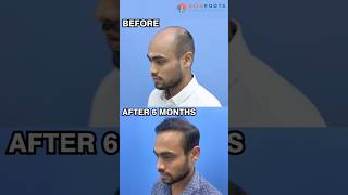 Hair Transformation Challenge  Dr Alok Sahoo hairlosstreatment realhairtransplant hairlosscure [upl. by Aderfla]