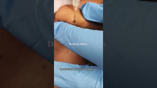 Preparation of Mole removalmoletreatment shorts trending laser drrichadubey drrichadubey [upl. by Navoj58]