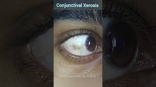 Xerophthalmia  Conjunctival Xerosis  Vitamin A Deficiencies [upl. by Enilesor]