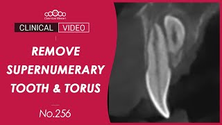 Extraction of supernumerary tooth  Lingual torus removal  Dr Cho Yongseok [upl. by Victoir]