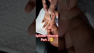 Splinter removal part 2 pain spiritualhealer [upl. by Immac604]