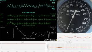 Tachycardia Male Heartbeat  wECG BP SPo2 10022024 [upl. by Sacram760]