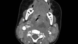 Retropharyngeal Abscess Imaging Studies short version [upl. by Edana]