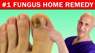 1 Best Home Remedy Cure for Toenail Fungus Dr Mandell [upl. by Yelnik]