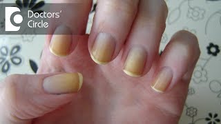 What can cause yellow discoloration of nails with dizziness and blackouts  Dr Sharat Honnatti [upl. by Llesirg]