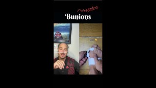 Do you have BUNIONS Try Chiropractor So Cal Chiropractic ​ [upl. by Afnin]