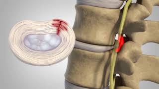 Herniated Disc  Patient Education [upl. by Rosanna]