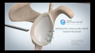 ARTHROSCOPIC SHOULDER STABILISATION BANKART PROCEDURE  DR MATTHIEU MEYER  PARIS FRANCE [upl. by Clarita]