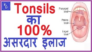 गले में टोन्सिल का 100 असरदार घरेलु इलाज  tonsils ka ramban ilaj  home remedy for tonsils [upl. by Coppola]