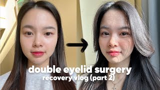 DOUBLE EYELID SURGERY RECOVERY VLOG PART 2  Braun Plastic Surgery South Korea 🇰🇷 [upl. by Domenic746]