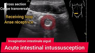 Invagination Intestinale Aiguë Grêlique Adulte Résolution spontanée Échographie [upl. by Aicina]