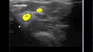 C5C6 cervical nerve root blocks [upl. by Sousa278]