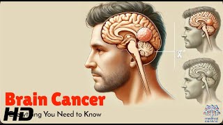 Brain Cancer 101 What You Need to Know About This Deadly Disease [upl. by Charie]