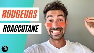 Comment Eviter Les Rougeurs Persistantes Dues Au Roaccutane Flush Erythrose Histamine [upl. by Mackenzie]