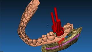 Trailer od a case of tooth autotransplantation performed with surgical guides [upl. by Lovel]