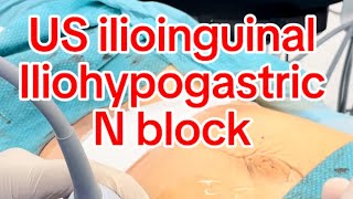 US guided Ilioinguinal iliohypogastric ns block [upl. by Armillia]