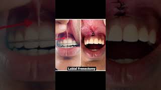 Labial Frenectomy after correcting Midline Diastema [upl. by Alodi266]