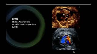 Fetal Ebstein noncompaction [upl. by Ainoval]