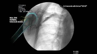 Arrow® EZIO® System  Proximal Humerus Infusion Fluoroscopy Adult Alert Patient [upl. by Oakley]