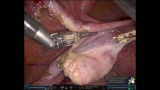 Easy Case Robotic  Reduced port jain technique [upl. by Rozalie]