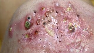 Big Cystic Acne Blackheads Extraction Blackheads amp Milia Whiteheads Removal Pimple Popping  3910 [upl. by Haff]