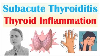 Subacute Thyroiditis Thyroid Inflammation De Quervain’s  Causes Symptoms Diagnosis Treatment [upl. by Kenn]