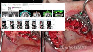 GuidedSMILE Dentate Natural Single Maxillary  Hamill [upl. by Rebbecca]