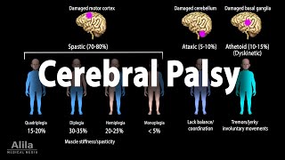 Cerebral Palsy Animation [upl. by Sabella148]