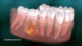 Dental Abcess  Why Root Canal Treatment Is Needed [upl. by Ramsa]