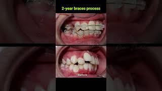 Braces evolution  2 years braces orthodontist dentist [upl. by Tyre293]