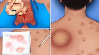 ASMR Remove back big pustule and pimple popping  Acne animation [upl. by Anayia732]