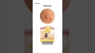 Acne Pimple Pus How to Get Rid of It  acne shorts [upl. by Nessi196]