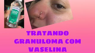 Piercing do nariz inflamado testando VASELINA no granuloma [upl. by Lered]