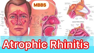 Atrophic Rhinitis [upl. by Amikahs408]