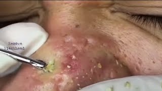 Acne Treatment Blackhead Removal on his nose Remove Blackhead removeblackhead [upl. by Einalam]