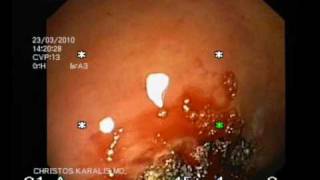 AVM OF THE COLON THERAPY WITH ARGON PLASMA LASER CHRISTOS KARALIS MDwmv [upl. by Aikrehs]