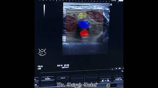 Sciatic nerve block at Popliteal fossa by Dr Sairah Sadaf for fx Tibia [upl. by Shellans826]