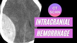 CT imaging of intracranial hemorrhage For medical students residents and clinicians [upl. by Nameloc]