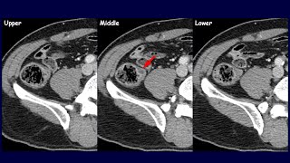 Is this an appendiceal lesion  Colitis cystica profunda amp Gastritis cystica profunda [upl. by Cirde312]