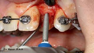 Dr Ziv Mazor Uses Dentatus ANEW Narrow Diameter Implant [upl. by Macur]