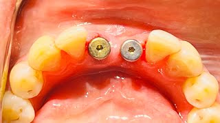 Guided Implant Surgery with 31 41 Neodent Straumann Dental Implant [upl. by Nytsirc]