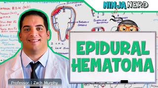 Epidural Hematoma  Anatomy Etiology Pathophysiology Clinical Features Treatment [upl. by Kristoffer]