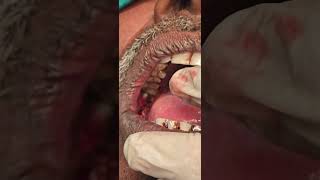 Verrucous carcinoma buccal mucosa excision unedited cautery laser  Dr Hitesh Patel [upl. by Lanti]