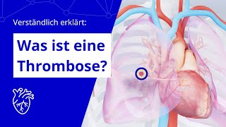 Verständlich erklärt Was ist eine Thrombose [upl. by Addam]