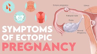 HEAVY SIGNS And SYMPTOMS Of ECTOPIC Pregnancy MOMMATTERS [upl. by Noedig]